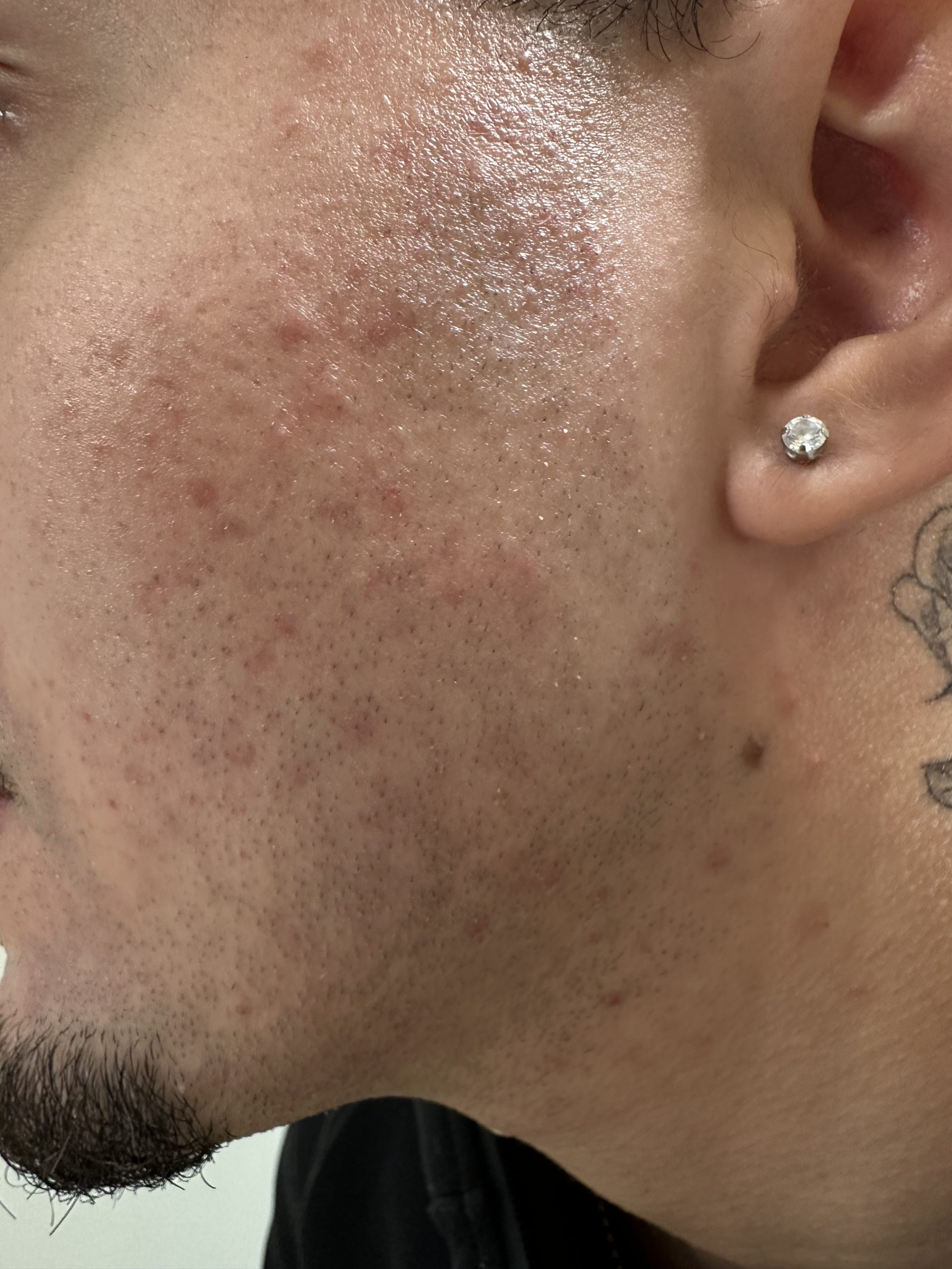 BARBE avant après épilation laser