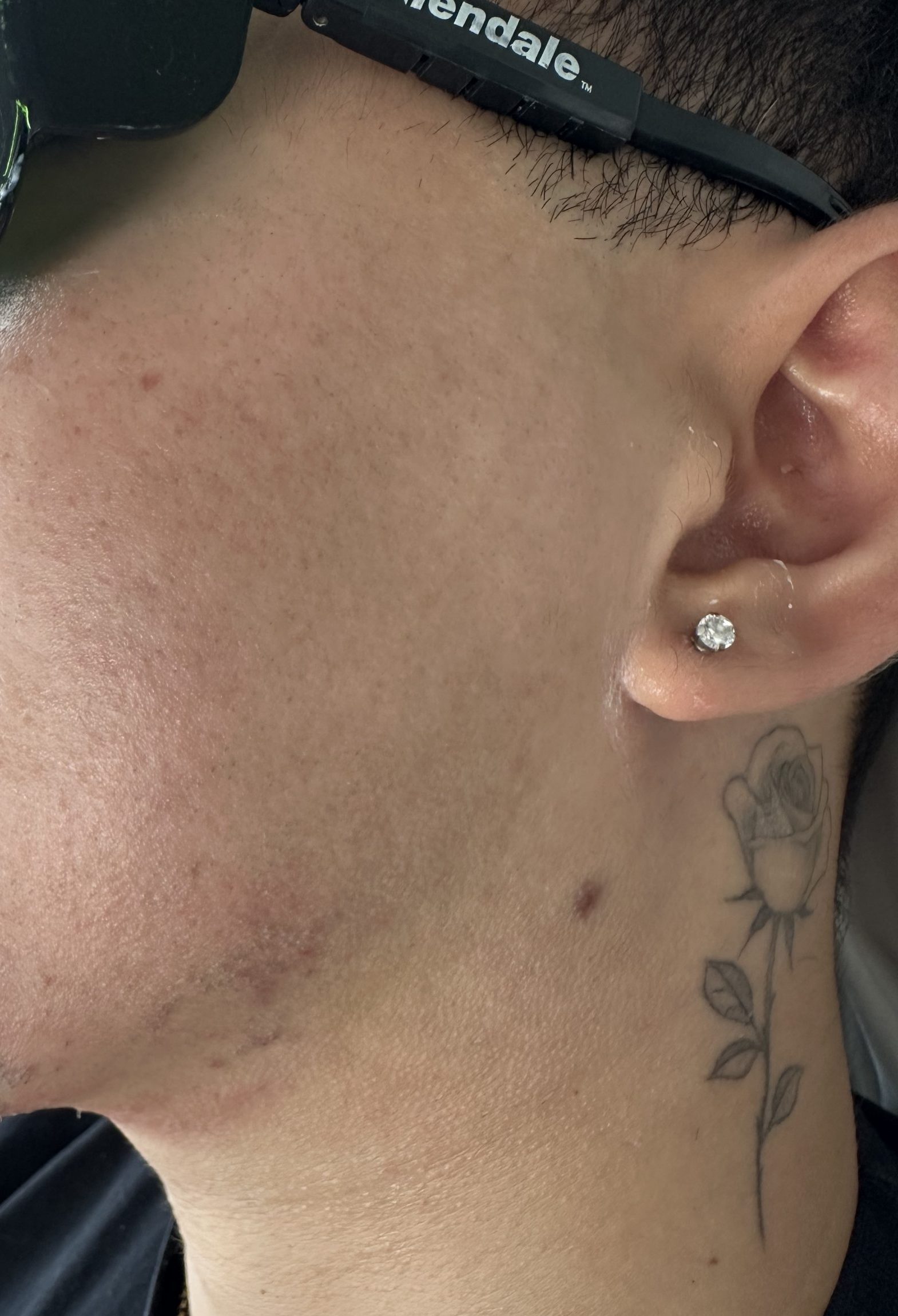 barbe avant après epilation laser