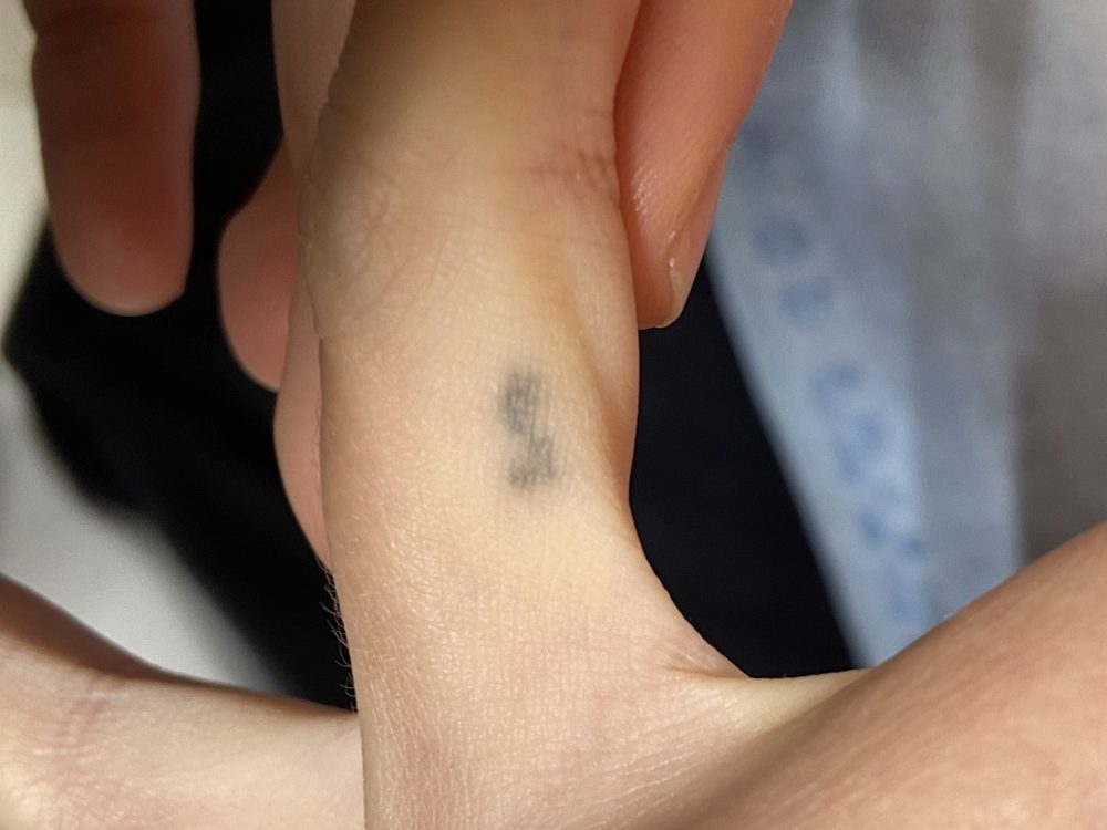 détatouage-anglet-après