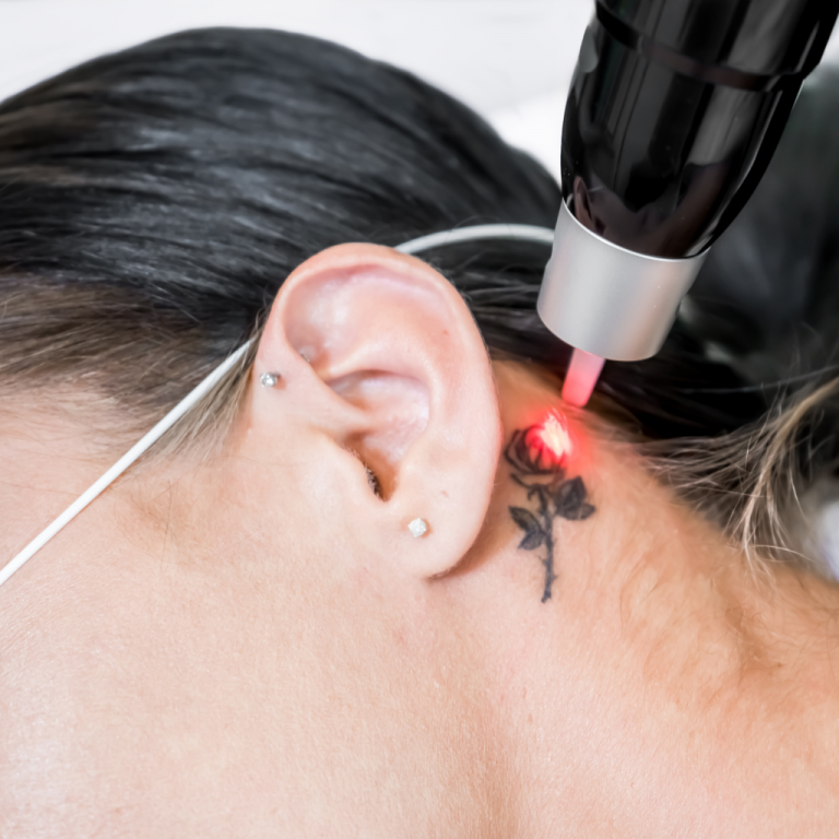 Séance de détatouage au laser Pico réalisée au centre (Be)OMA à Anglet