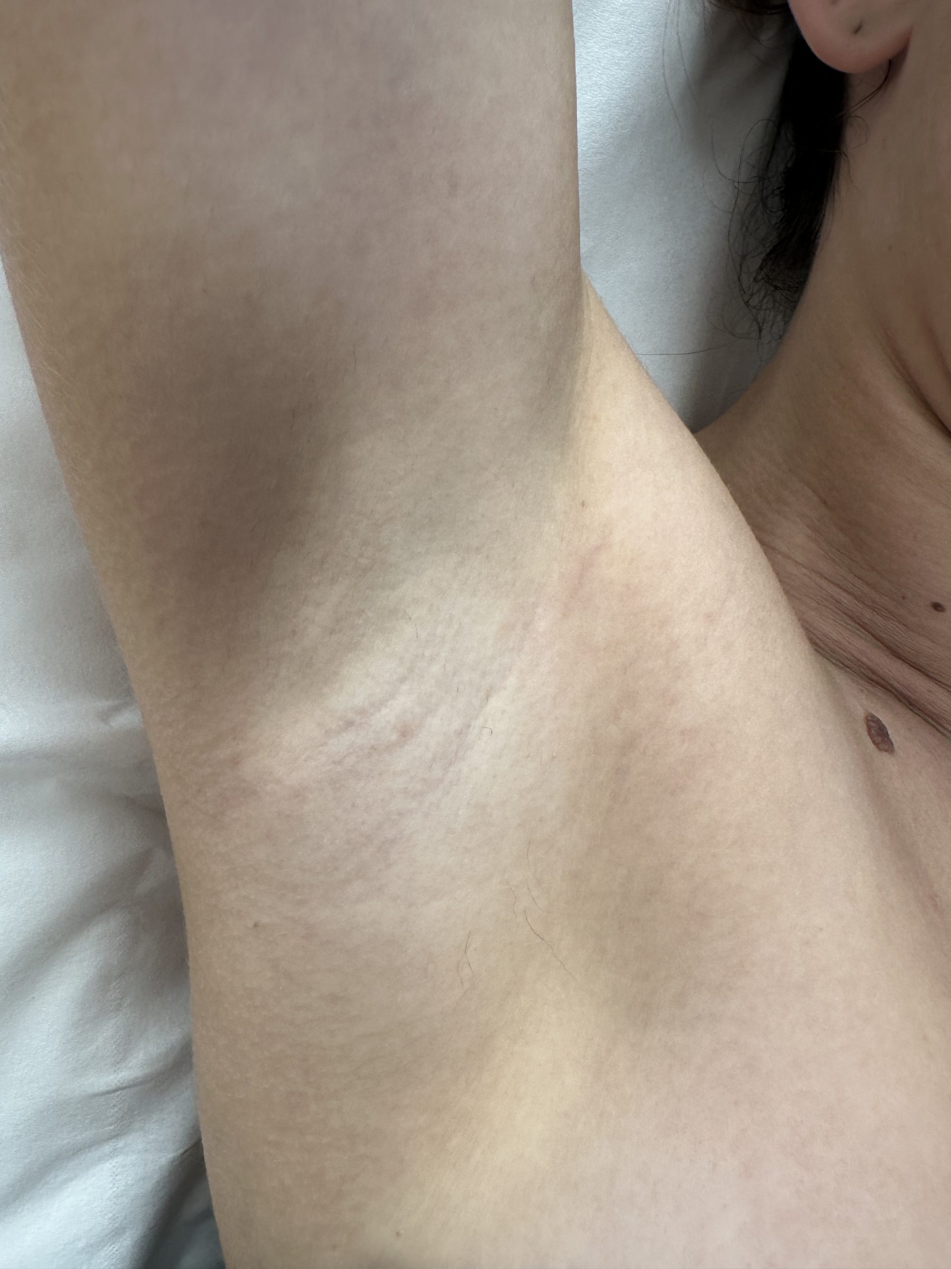 epilation laser anglet après