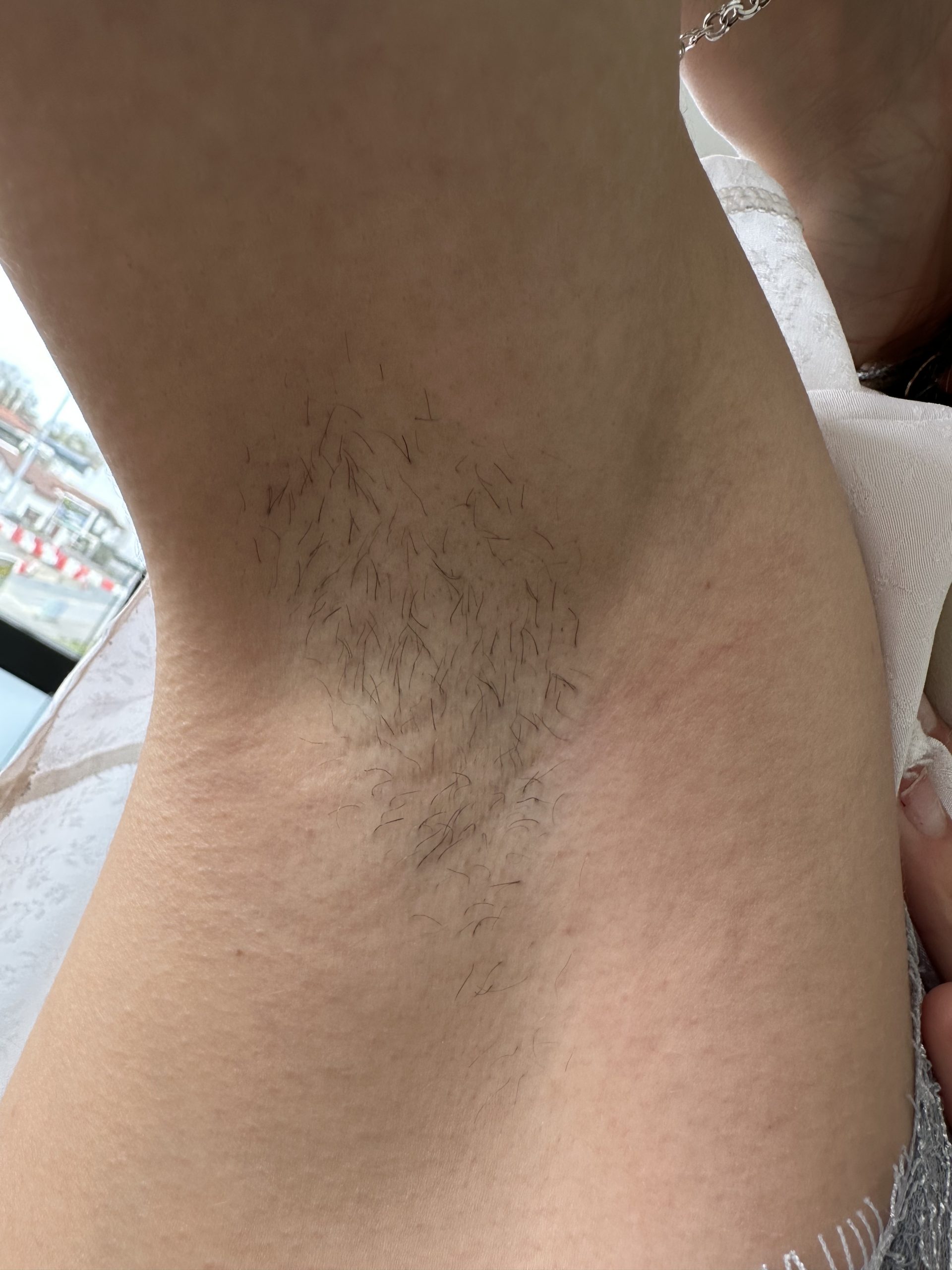 epilation laser anglet avant