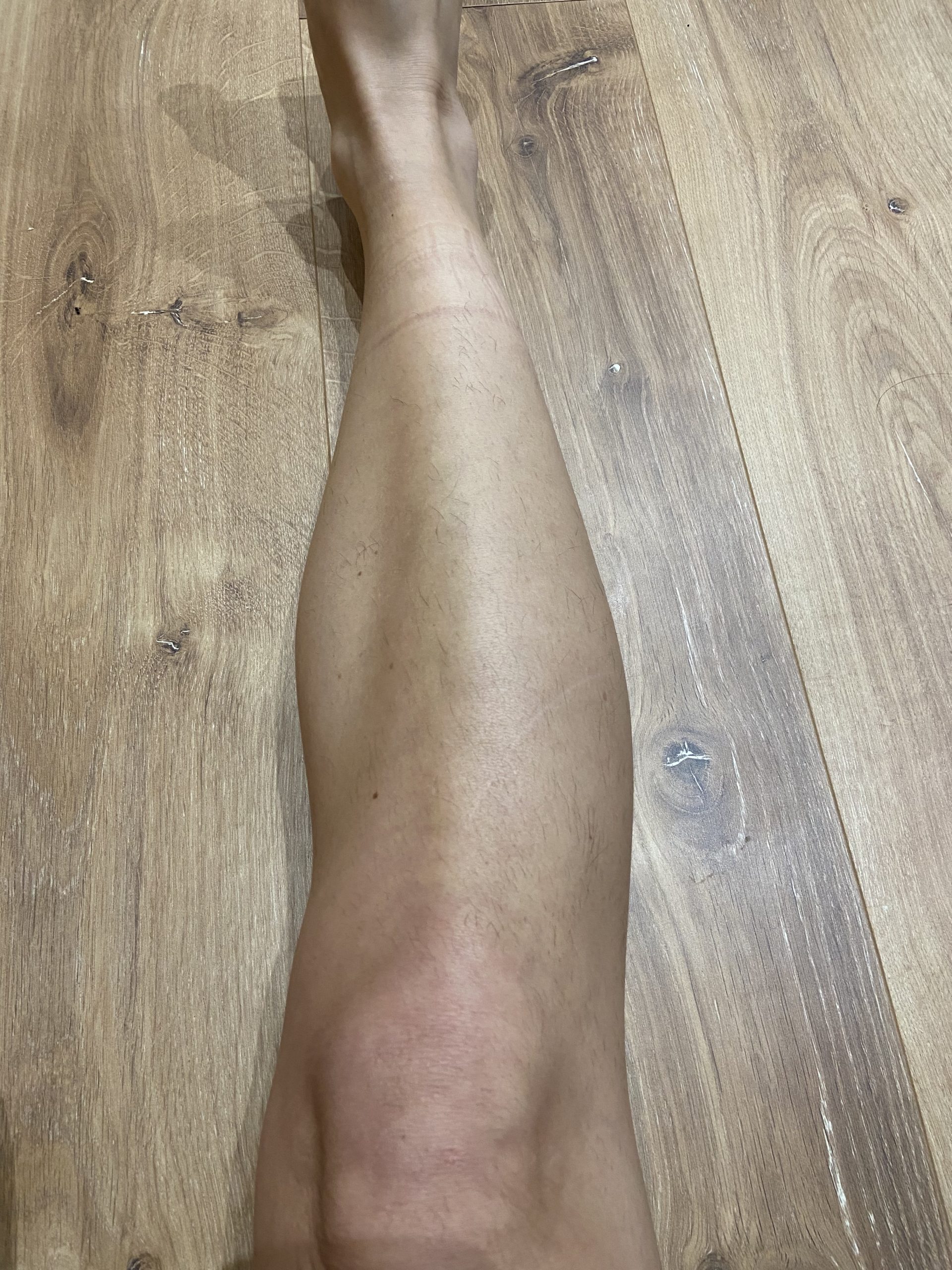 epilation laser jambes anglet après