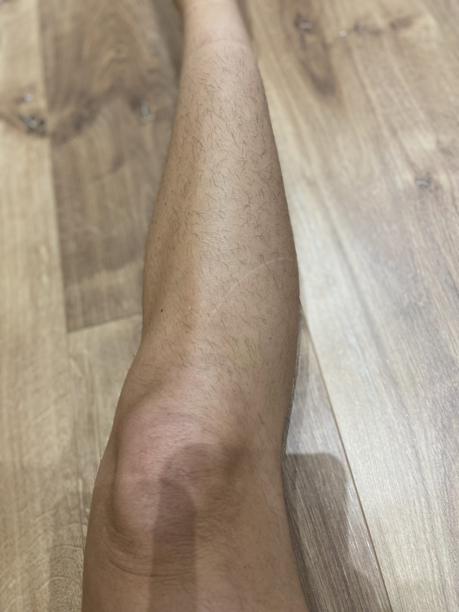 epilation laser jambes anglet avant