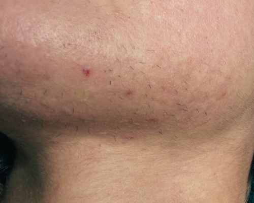 Avant après électrolyse 1