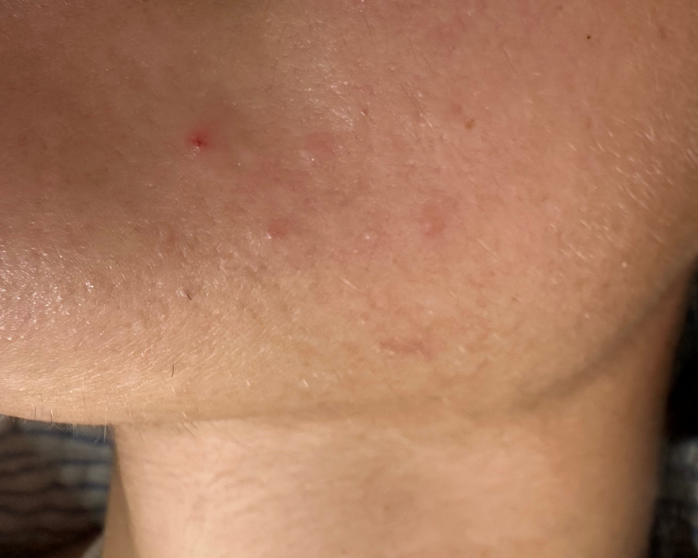 avant après électrolyse