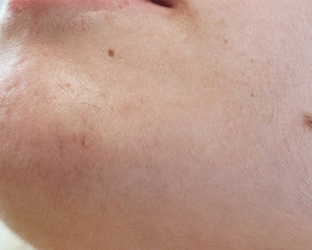 electrolyse avant après