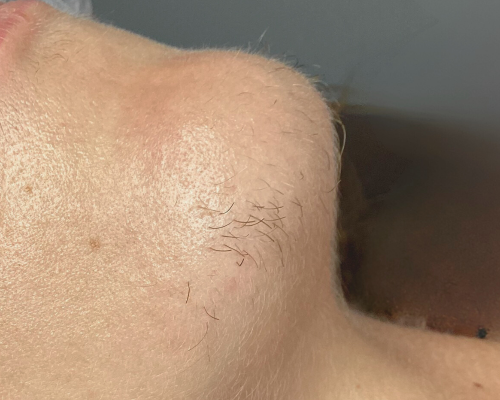 électrolyse avant après