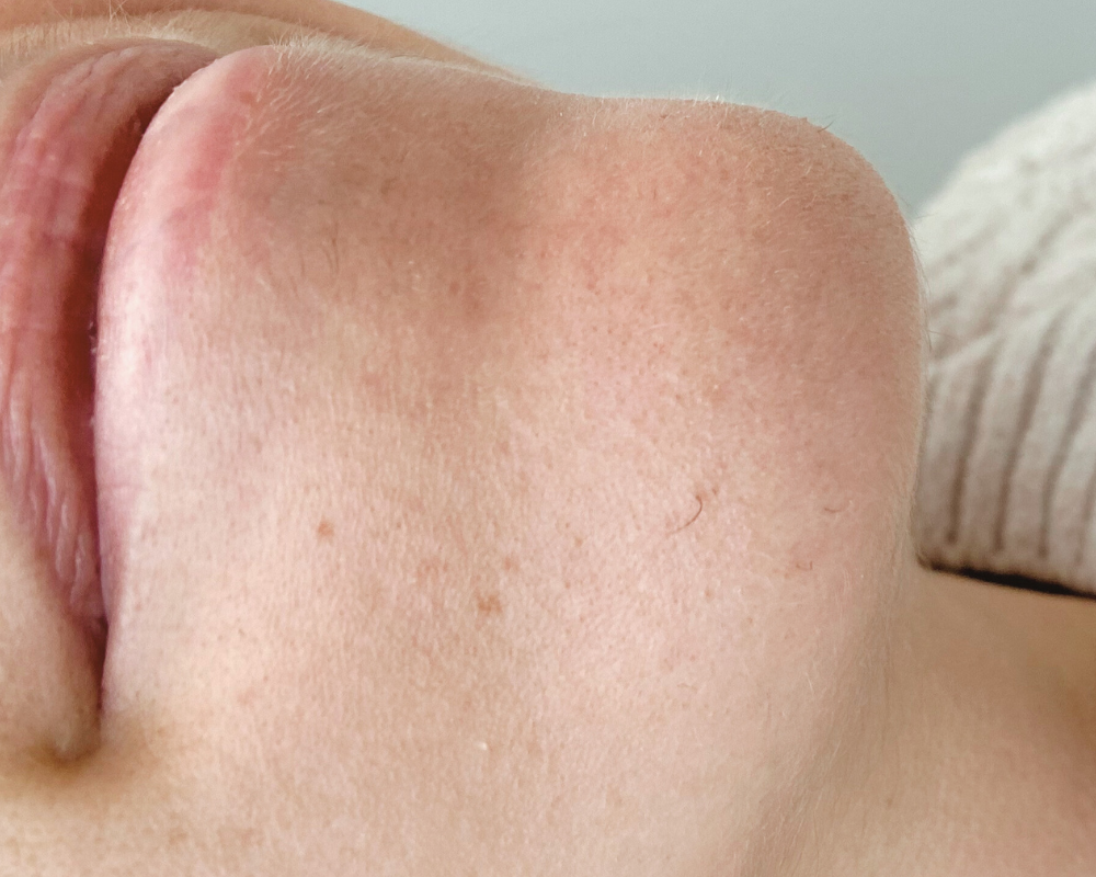 electrolyse avant apres